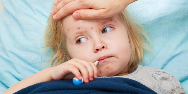 Varicella Varicella sintomi vaccino e cura